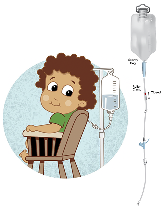 Boy with bolus feeding by gravity bag